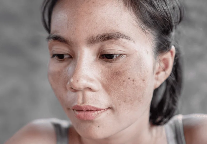 How to Manage Sun Damage: What You Need To Know