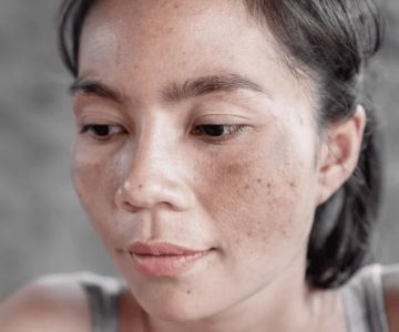 How to Manage Sun Damage: What You Need To Know