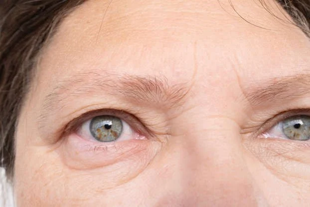 Expert Advice on Puffy Eyes in People Over 40 – Causes and Solutions