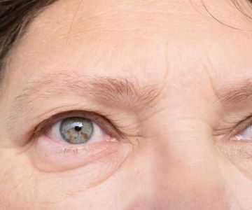 Expert Advice on Puffy Eyes in People Over 40 – Causes and Solutions