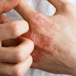 Best Practices For Inflamed Skin In Dry Climates