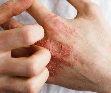 Best Practices For Inflamed Skin In Dry Climates