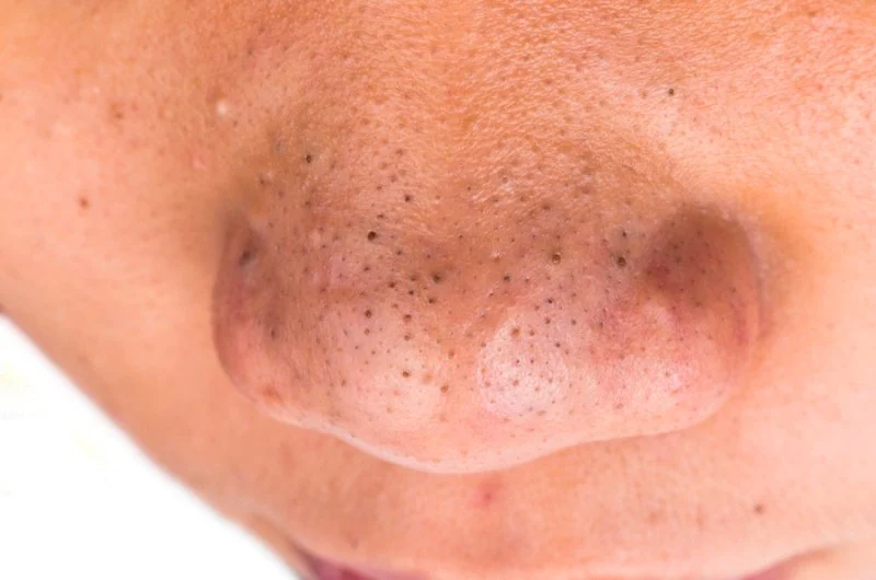 How To Repair Blackheads For Men: Tips and Treatments