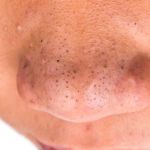 How To Repair Blackheads For Men: Tips and Treatments