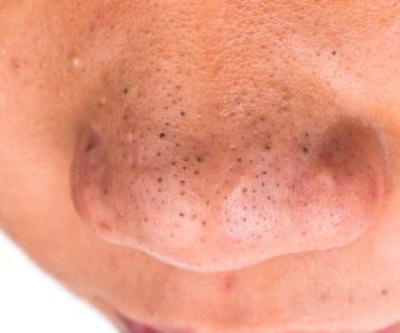 How To Repair Blackheads For Men: Tips and Treatments