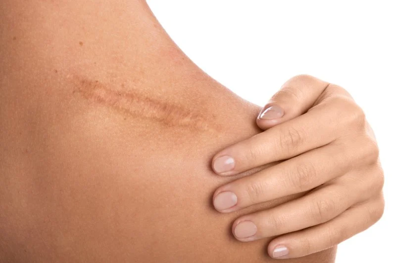 Best Practices for Treating Scars Effectively