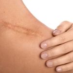 Best Practices for Treating Scars Effectively