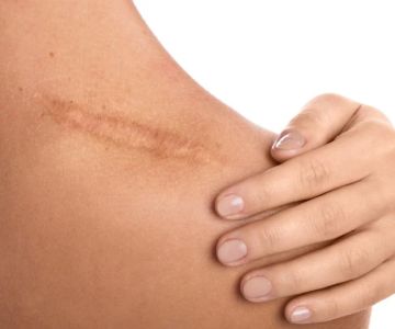 Best Practices for Treating Scars Effectively