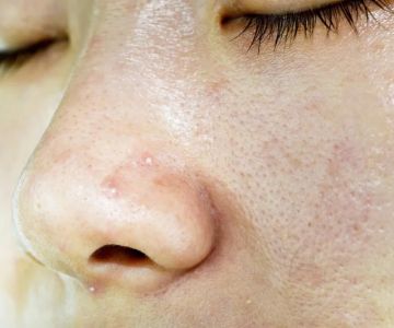 How To Prevent Hyaluronic Acid From Causing Whiteheads