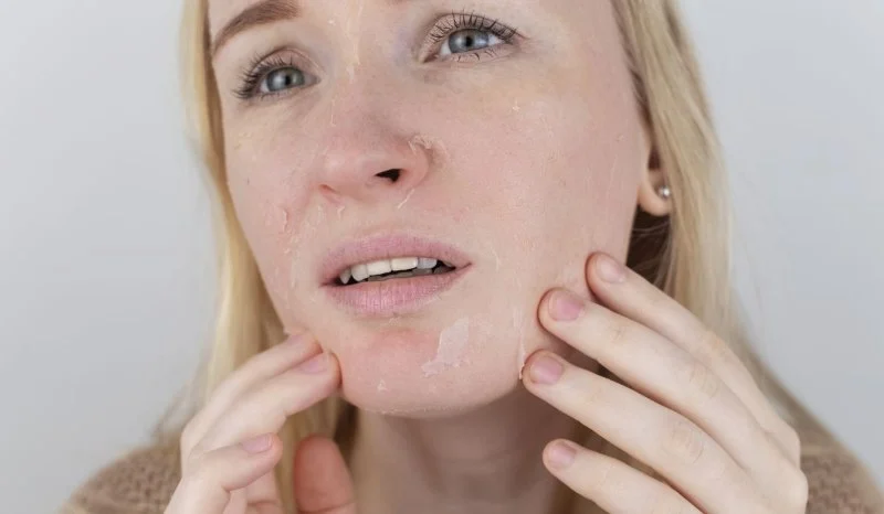 How To Treat Dry Skin: What You Need To Know