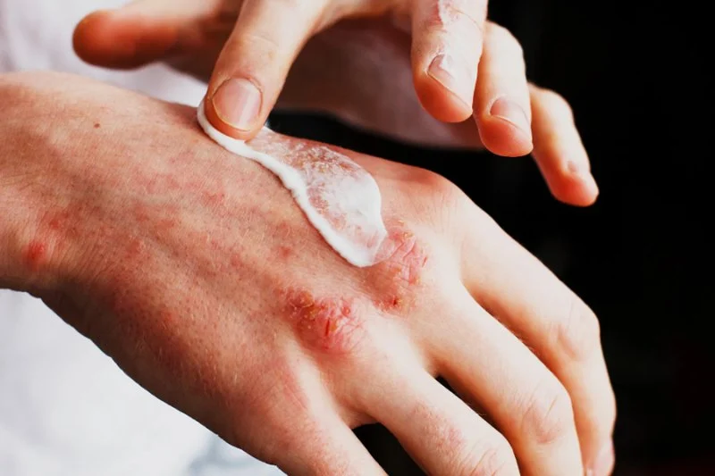 How to Effectively Treat Eczema in People with Combination Skin