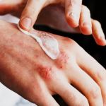How to Effectively Treat Eczema in People with Combination Skin