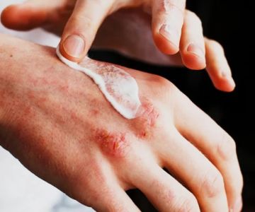 How to Effectively Treat Eczema in People with Combination Skin