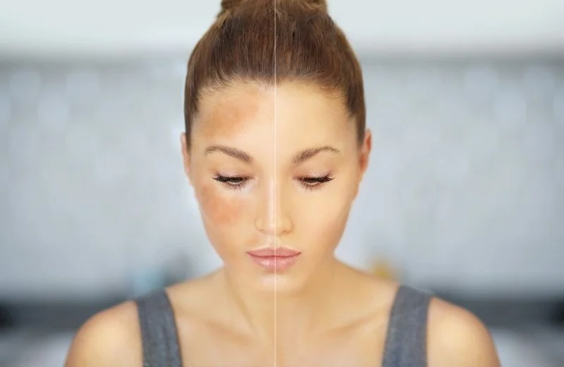 Best Products for Hyperpigmentation Using Natural Remedies