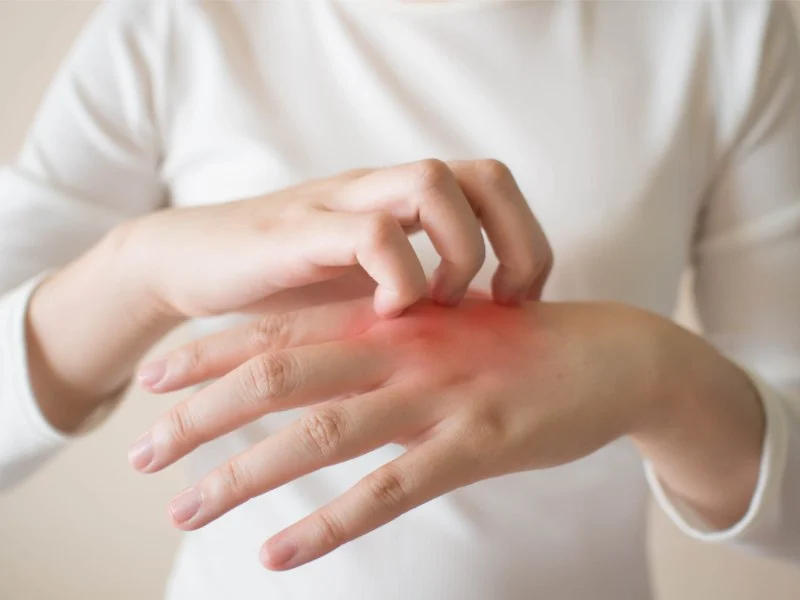 Skin Care Tips For Eczema: What You Need To Know