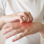 Skin Care Tips For Eczema: What You Need To Know