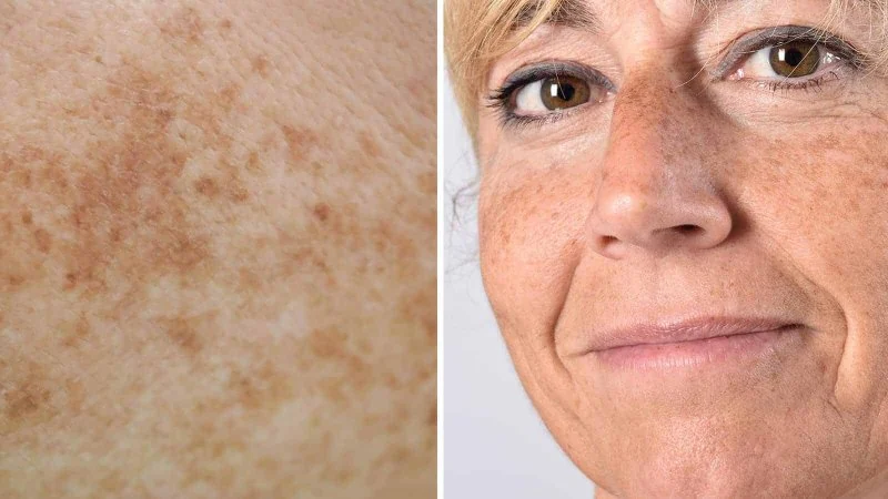 Natural Remedies For Your Age Spots With These 7 Tips