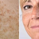 Natural Remedies For Your Age Spots With These 7 Tips