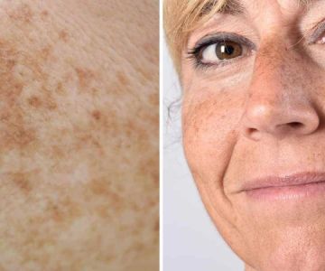 Natural Remedies For Your Age Spots With These 7 Tips