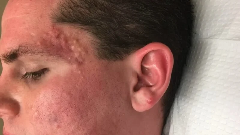 Whitehead Prevention and Treatment for Oily Skin