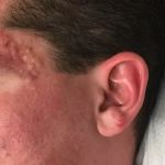 Whitehead Prevention and Treatment for Oily Skin