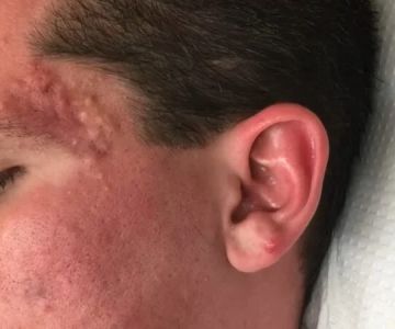 Whitehead Prevention and Treatment for Oily Skin