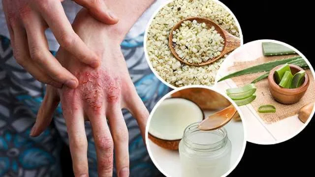 Natural Remedies For Eczema: What You Need To Know