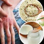 Natural Remedies For Eczema: What You Need To Know