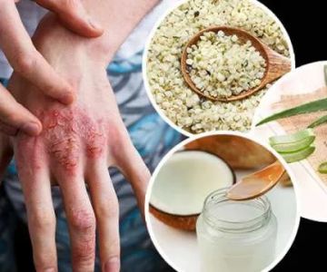 Natural Remedies For Eczema: What You Need To Know