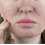 How to Boost Your Skin’s Large Pores: What You Need to Know