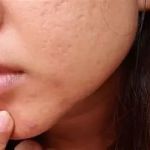 Guide To Skin Care Treatments For Blackheads For Women