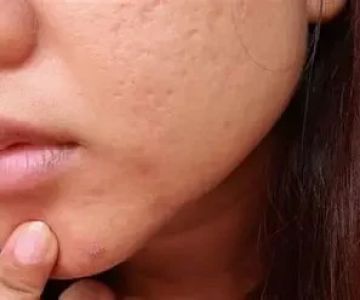 Guide To Skin Care Treatments For Blackheads For Women