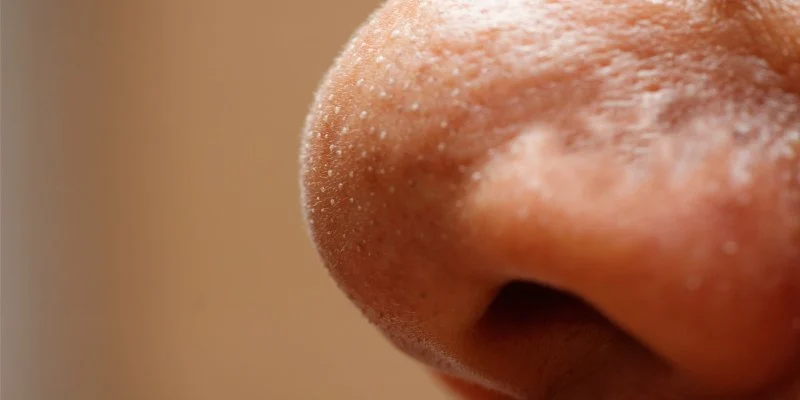 The Ultimate Guide to Whitehead Treatment: 7 Expert Tips for Clear Skin