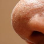 The Ultimate Guide to Whitehead Treatment: 7 Expert Tips for Clear Skin