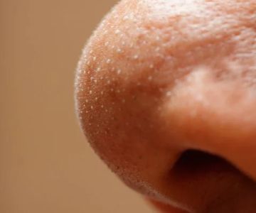 The Ultimate Guide to Whitehead Treatment: 7 Expert Tips for Clear Skin