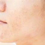 Everything You Need To Know About Dark Spots and How to Manage Them