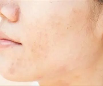 Everything You Need To Know About Dark Spots and How to Manage Them