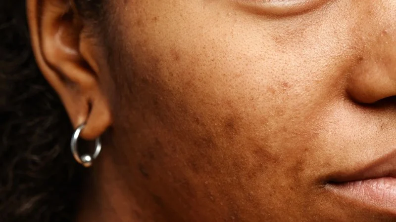 How to Heal Uneven Skin Tone in Dry Skin | Tips & Remedies