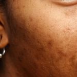 How to Heal Uneven Skin Tone in Dry Skin | Tips & Remedies