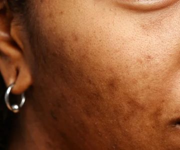 How to Heal Uneven Skin Tone in Dry Skin | Tips & Remedies