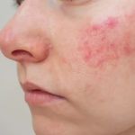 Natural Remedies for Rosacea Relief: How to Brighten Your Skin