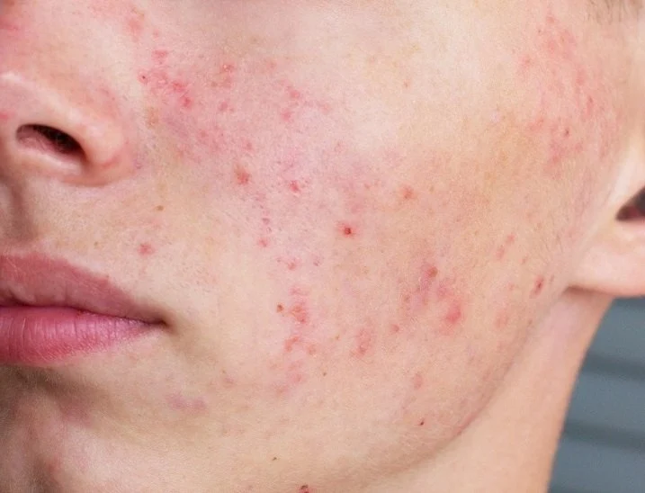 How to Prevent Redness Effectively: Tips and Treatments