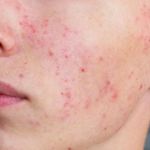 How to Prevent Redness Effectively: Tips and Treatments