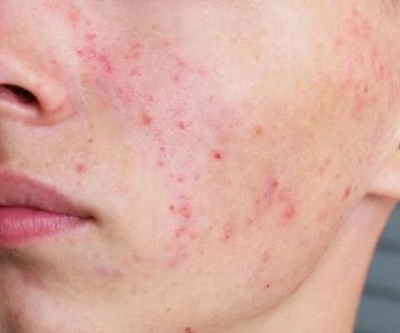 How to Prevent Redness Effectively: Tips and Treatments