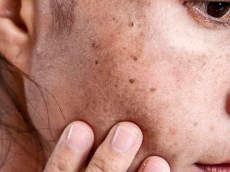 Ultimate Guide to Age Spots: How to Treat and Prevent Them Effectively