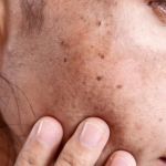 Ultimate Guide to Age Spots: How to Treat and Prevent Them Effectively