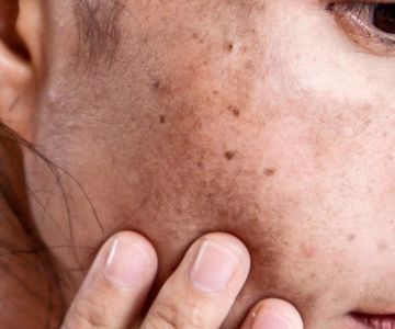 Ultimate Guide to Age Spots: How to Treat and Prevent Them Effectively