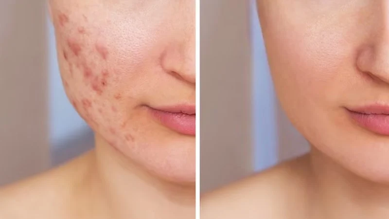 Effective Skin Care Tips for Scars: Healing and Improving Appearance