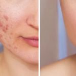 Effective Skin Care Tips for Scars: Healing and Improving Appearance