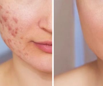 Effective Skin Care Tips for Scars: Healing and Improving Appearance